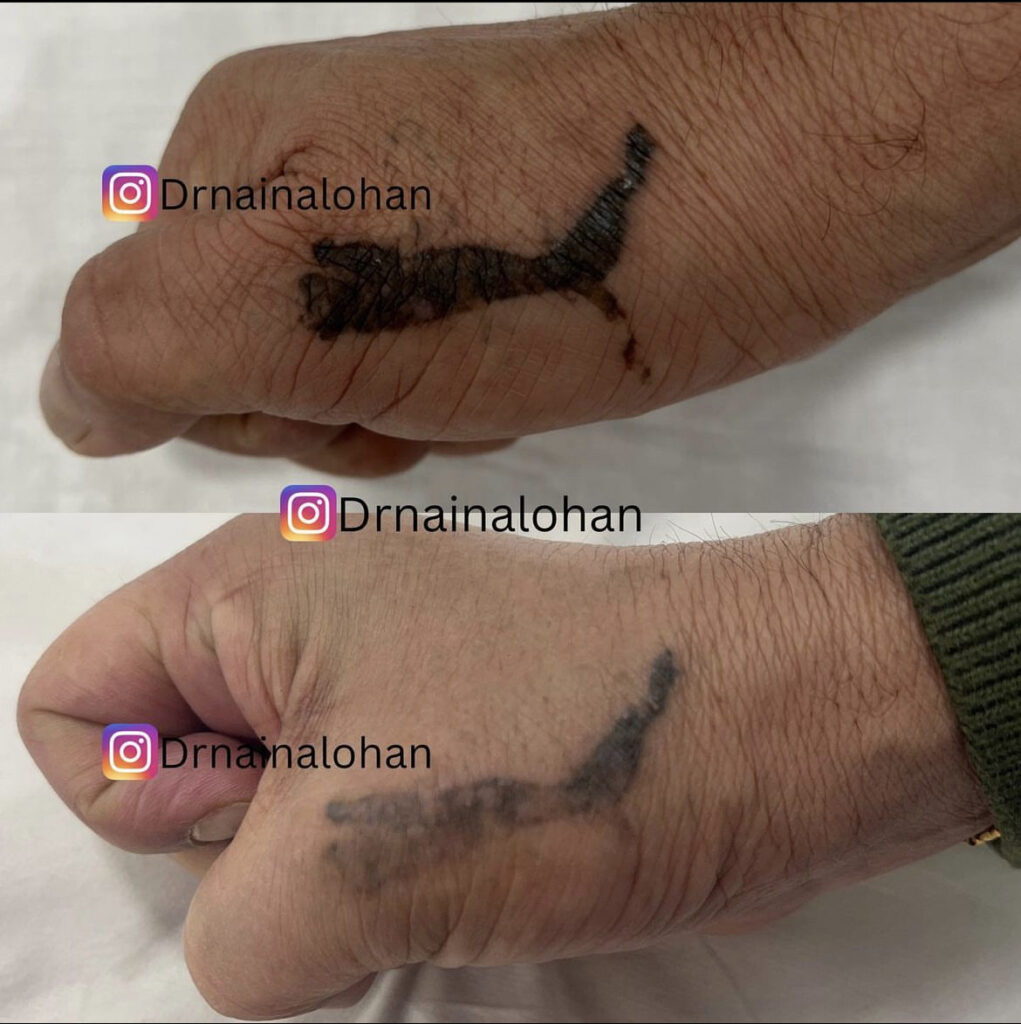 Tattoo Removal - Dr Naina Lohan